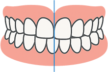 前歯のズレ