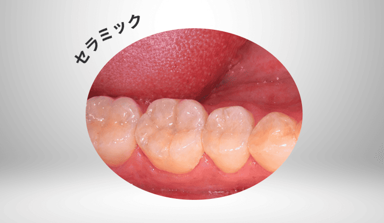 セラミックのイメージ