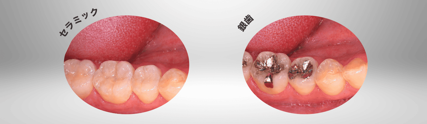 セラミックと銀歯の違い