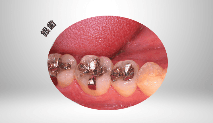 銀歯のイメージ