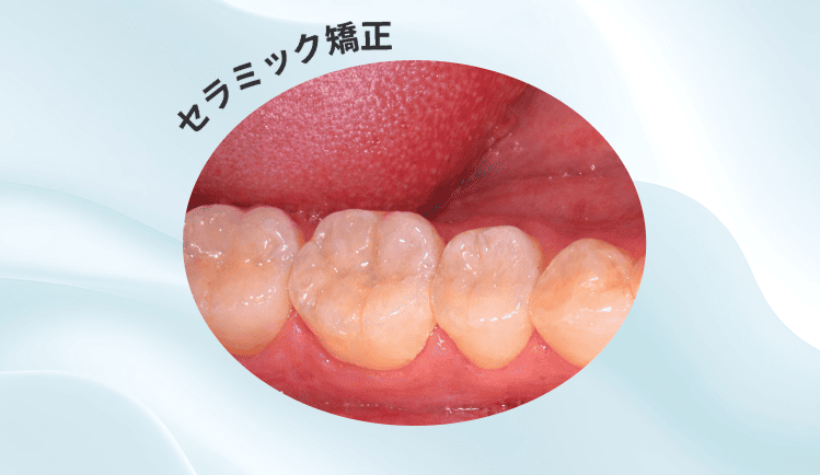 セラミック矯正のイメージ