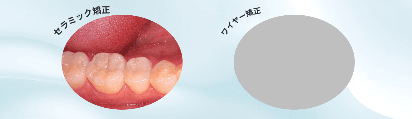 セラミック矯正とワイヤー矯正の違い