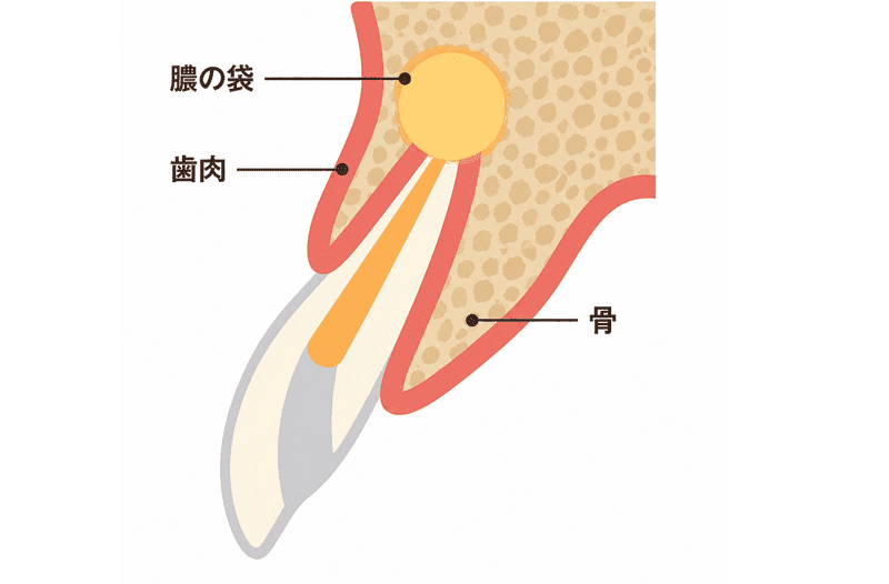 歯肉を切開する