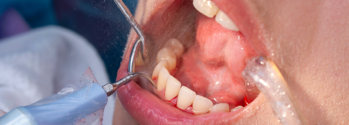 歯垢・歯石・バイオフィルムの除去