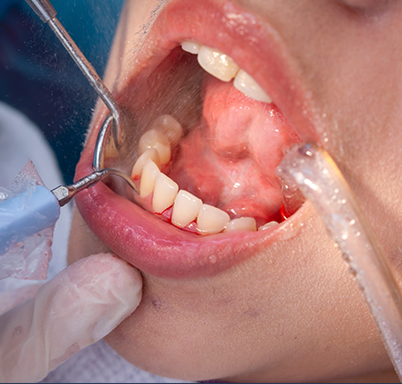 歯垢・歯石・バイオフィルムの除去