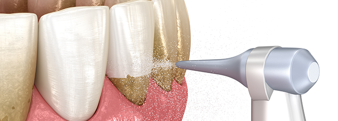 エアフロー・パウダージェットの使用