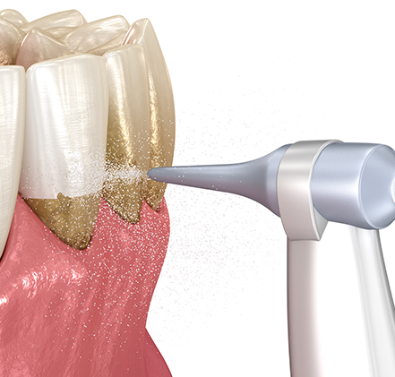 エアフロー・パウダージェットの使用